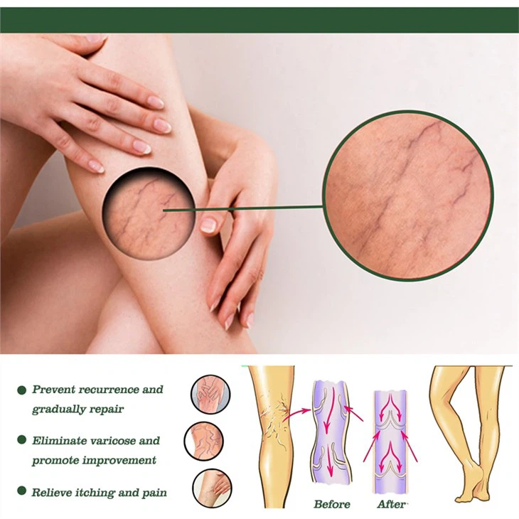 Varicose Veins Treatment Soap