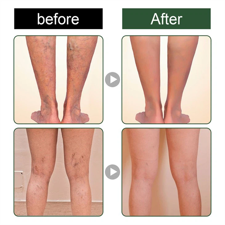 Varicose Veins Treatment Soap