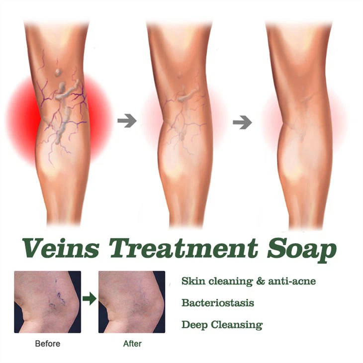 Varicose Veins Treatment Soap